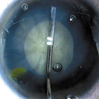 Facoemulsificaci&oacute;n