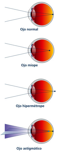 Defectos de refracci&oacute;n