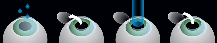 La t&eacute;cnica lasik paso a paso